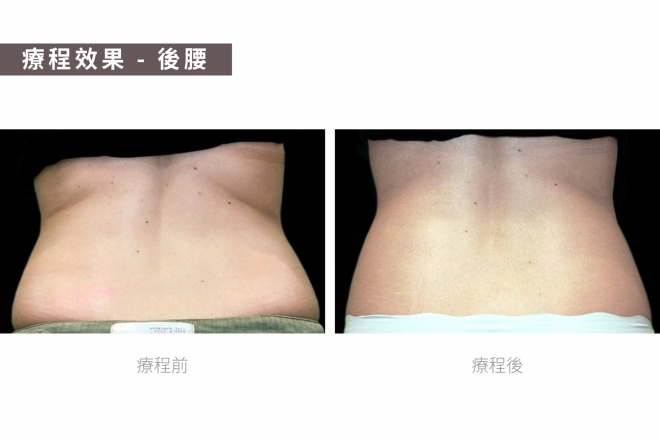 BTL隔空溶脂_TM圖-04