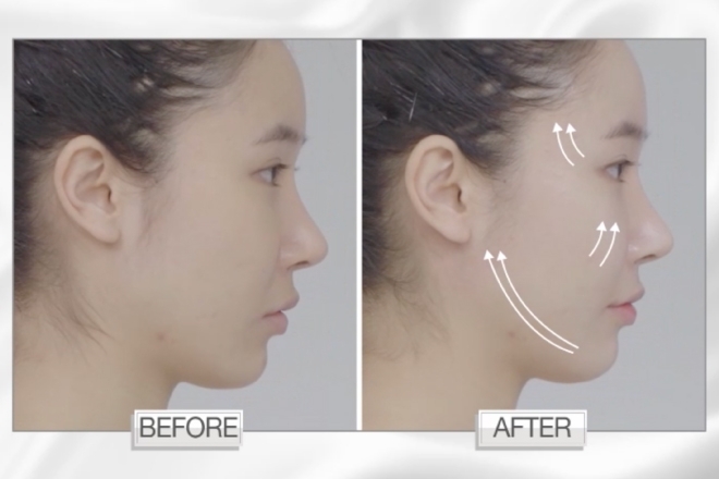 無痛 MFU V面提拉去皺 _660x440_工作區域 1