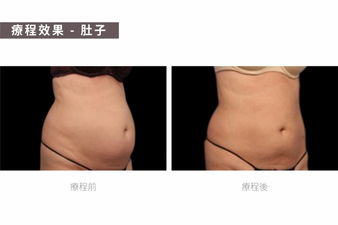 BTL隔空溶脂_TM圖-03